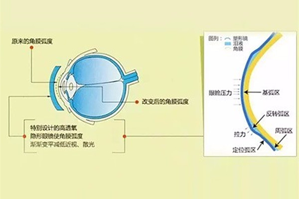 角膜塑形镜控制近视效果的影响因素包括哪些 角膜塑形镜控制近视效果的影响因素包括哪些