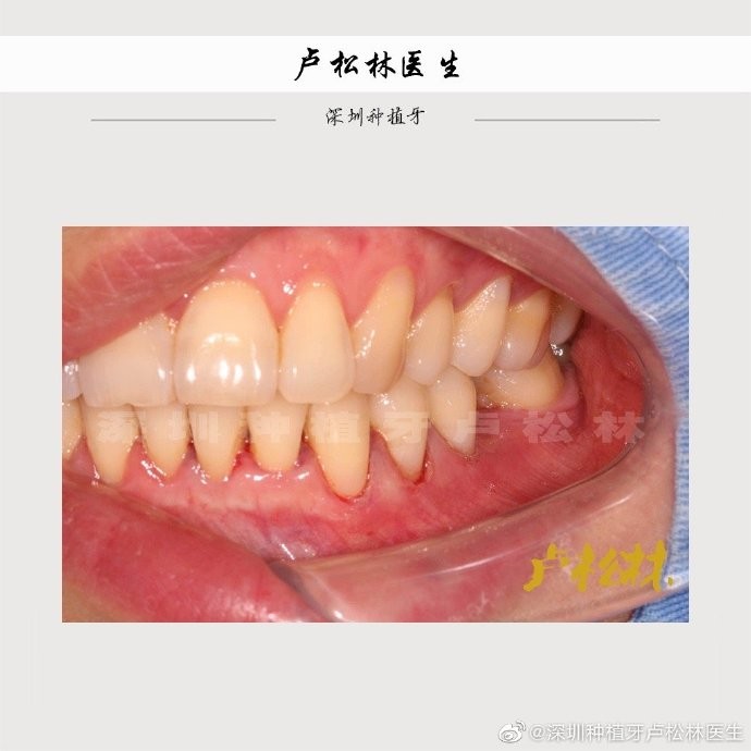 深圳种牙咨询人员更关心哪些种牙的问题 深圳种牙咨询人员更关心哪些种牙的问题