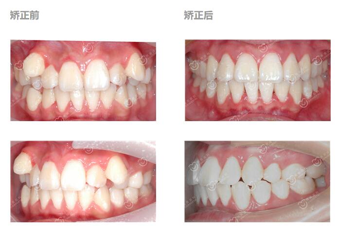 深圳牙齿矫正之后应注意什么 深圳牙齿矫正之后应注意什么