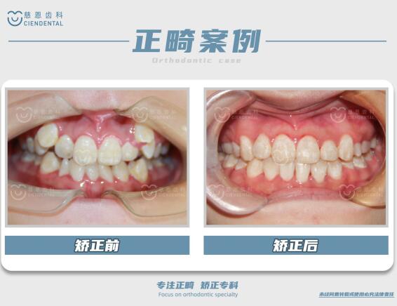 深圳牙齿矫正1.jpg 深圳牙齿矫正1.jpg