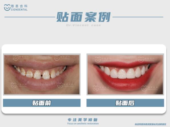 深圳牙齿美容2.jpg 深圳牙齿美容2.jpg