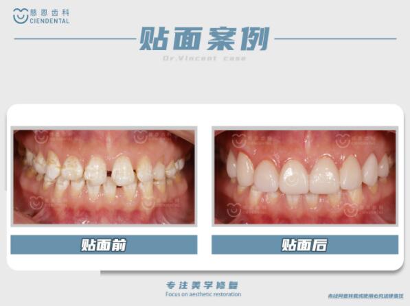 深圳牙齿美容3.jpg 深圳牙齿美容3.jpg