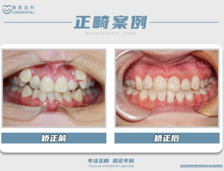 深圳牙齿矫正 3.png 深圳牙齿矫正 3.png